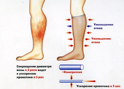 Как работают гетры при варикозе