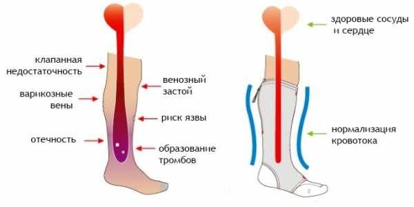 Компрессионные чулки при каких болезнях