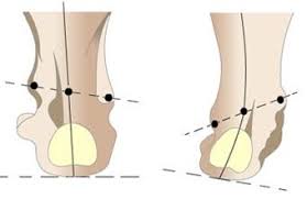 Нормальная и варусная стопа