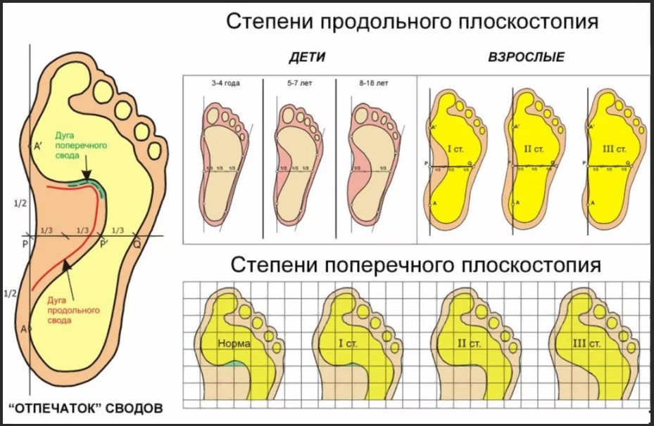 плоскостопие 4